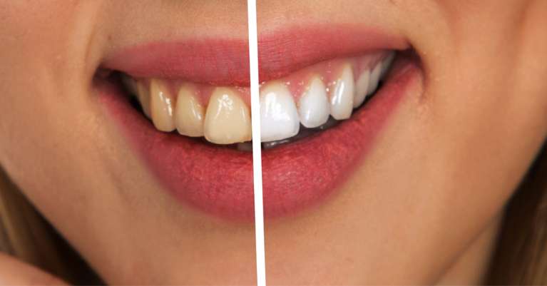 Fogfehérítés Dunaújvárosban